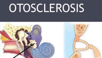 Otosclerosis