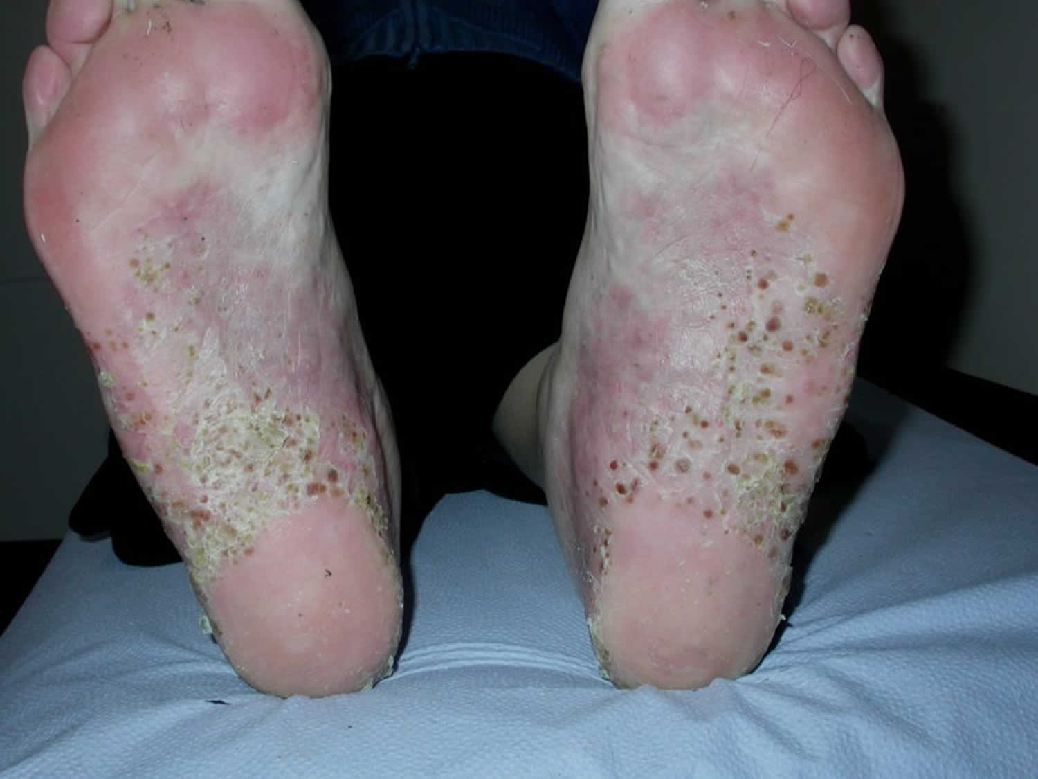 Palmoplantar pustulosis.