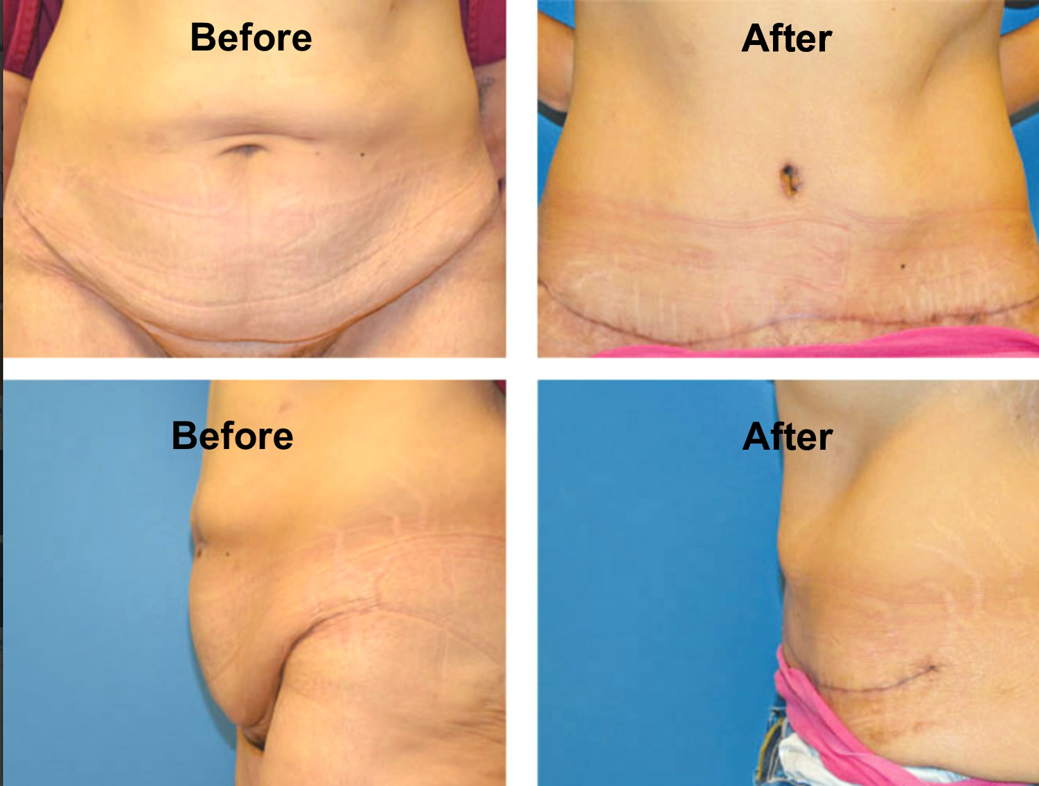 Panniculectomy before and after