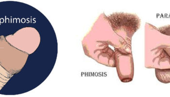 Paraphimosis