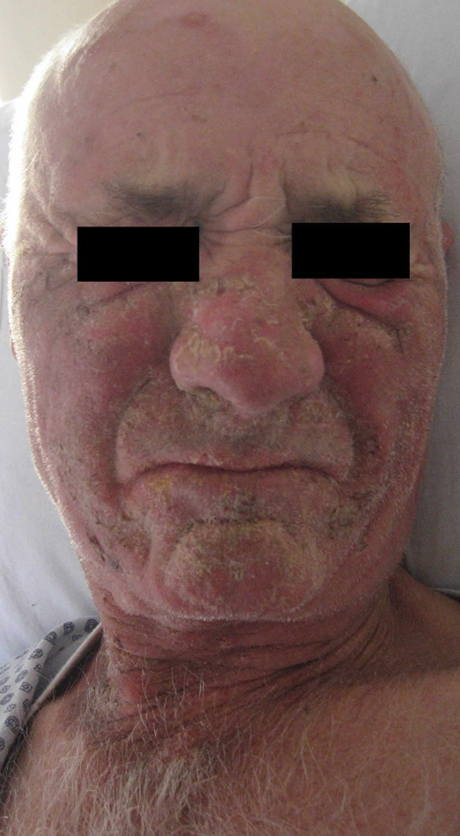Pellagra dermatitis