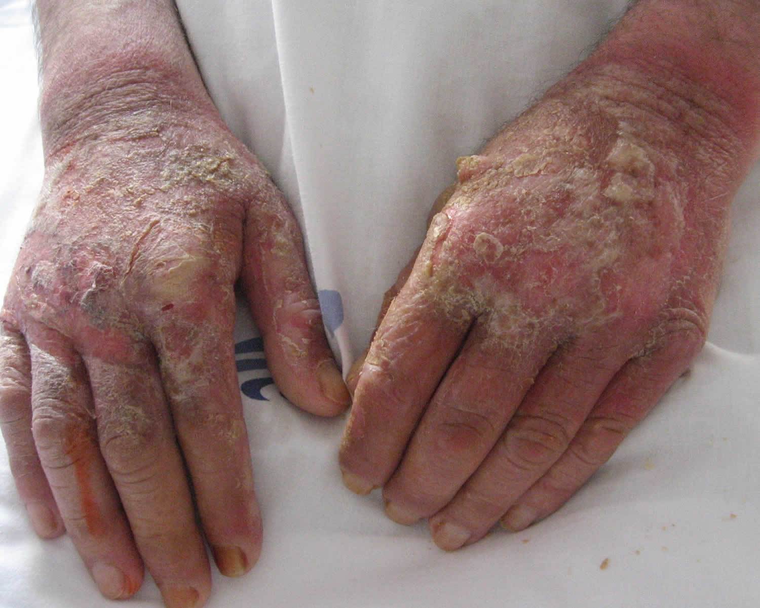 Pellagra dermatitis