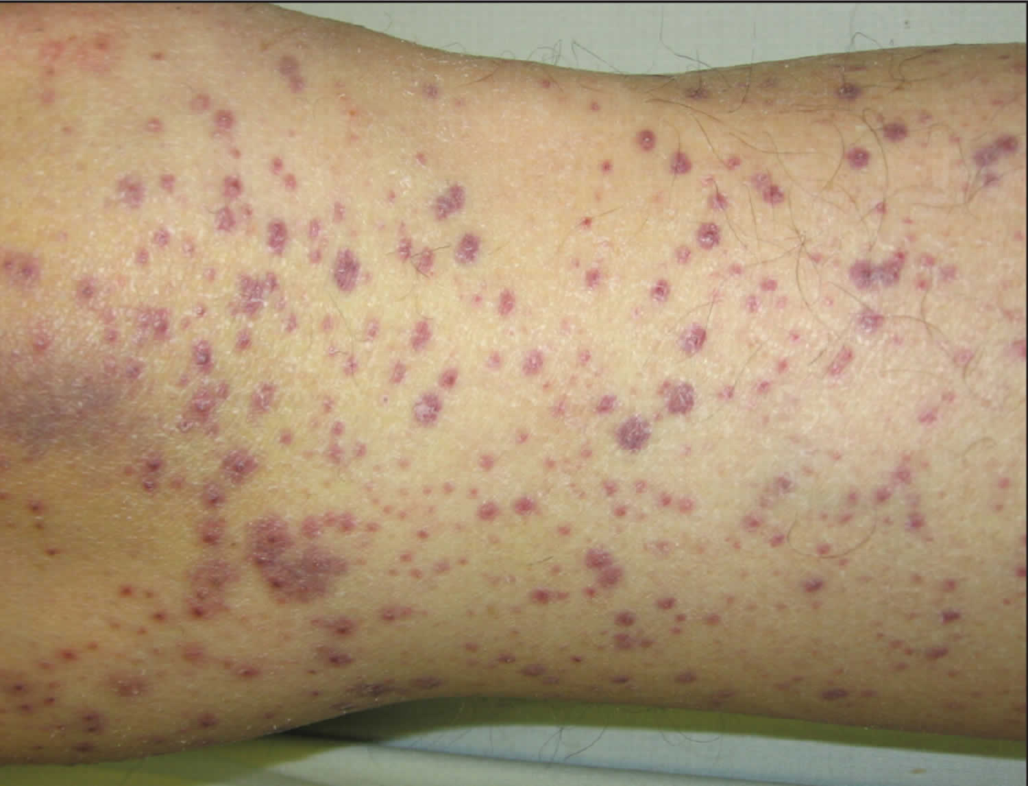 Perifollicular hemorrhagic papules