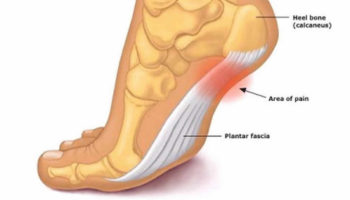 Plantar fasciitis