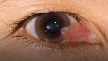 Pterygium