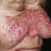 Rhinophyma