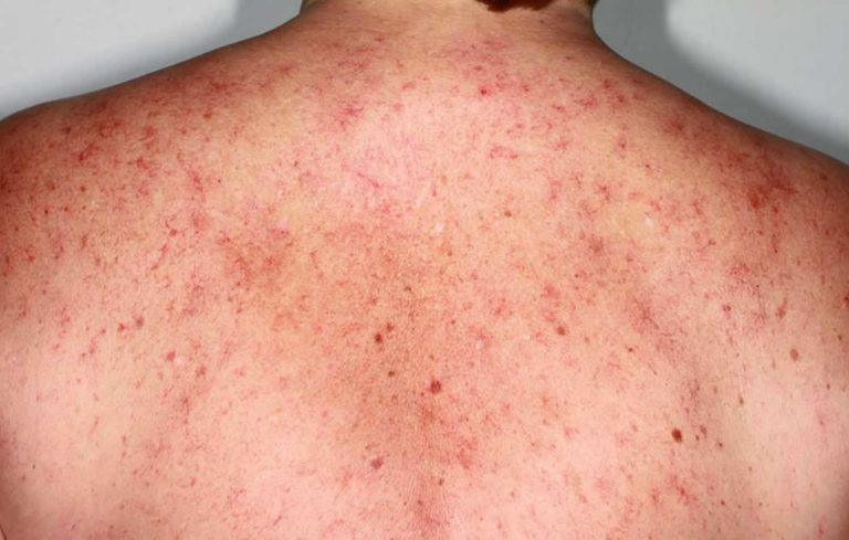 Spider angioma causes, symptoms, diagnosis & spider angioma treatment