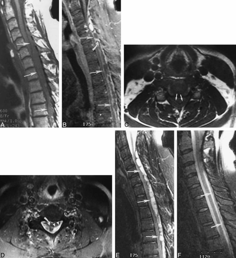 Epidural Hematoma Causes, Signs, Symptoms, Diagnosis & Treatment