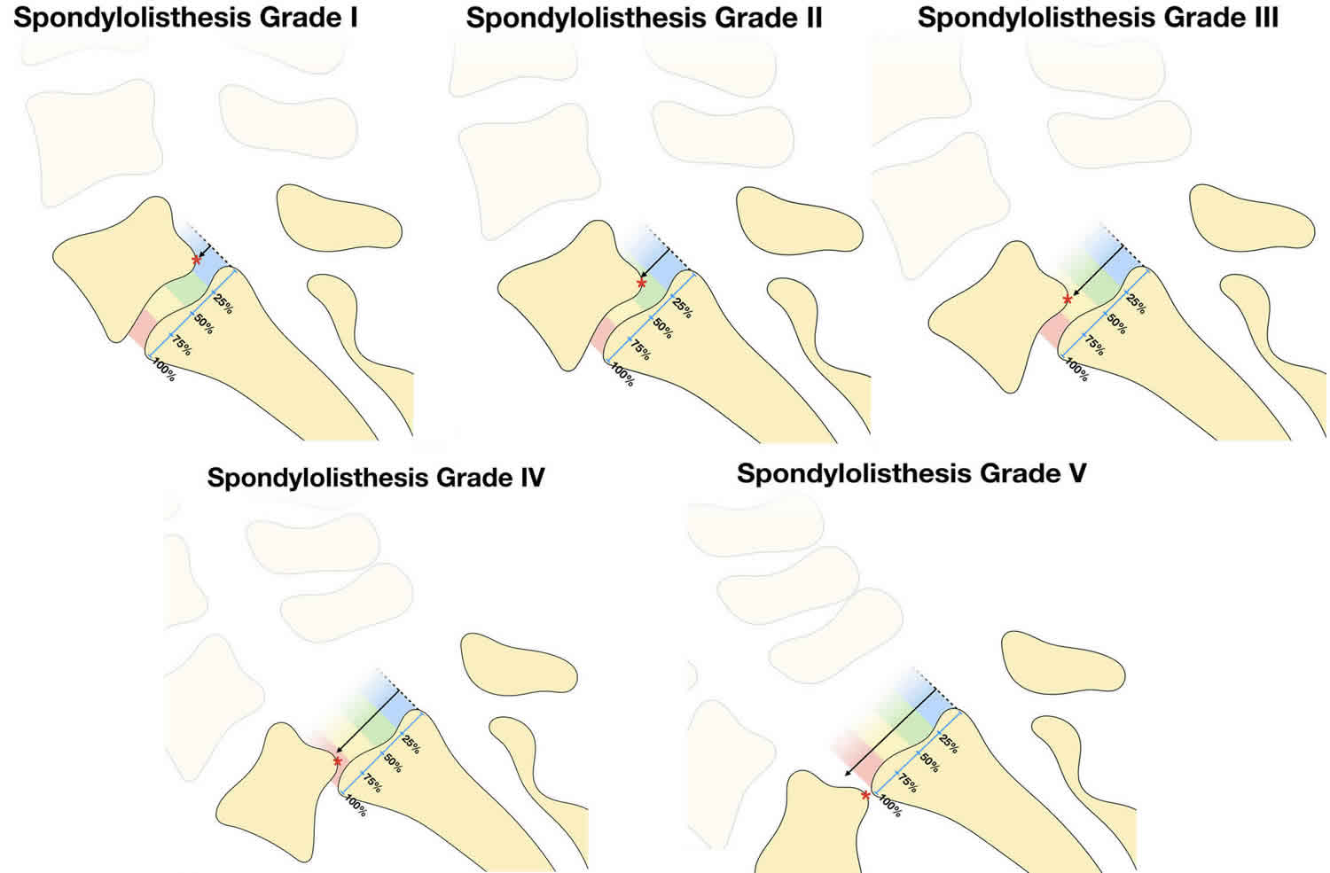 Spondylolisthesis grading