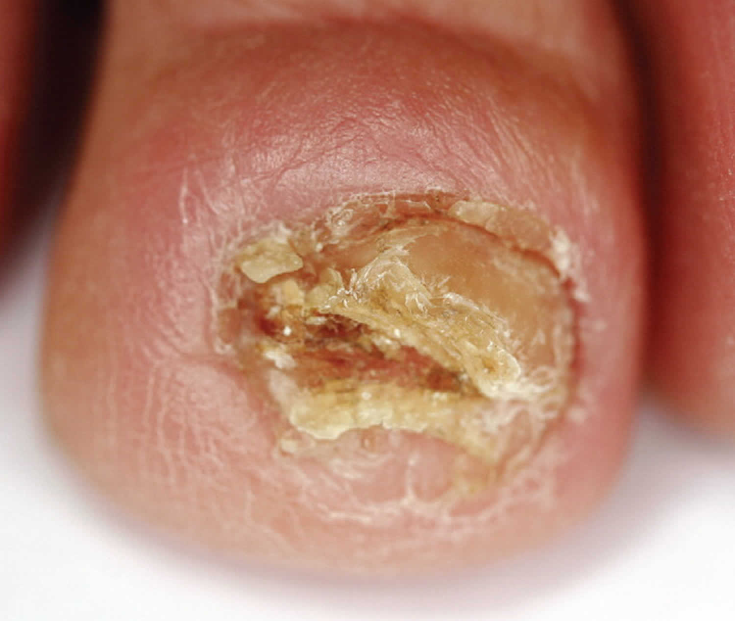 Types of Toenail Fungus: Pictures, Symptoms, Treatment