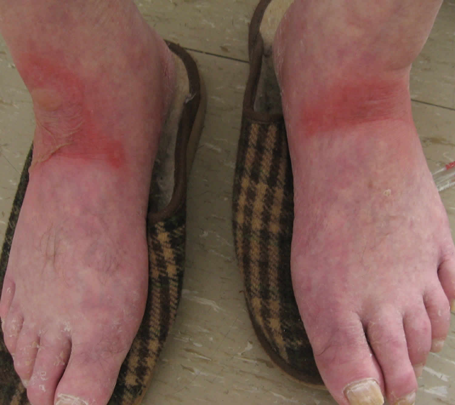Wet pellagra dermatitis