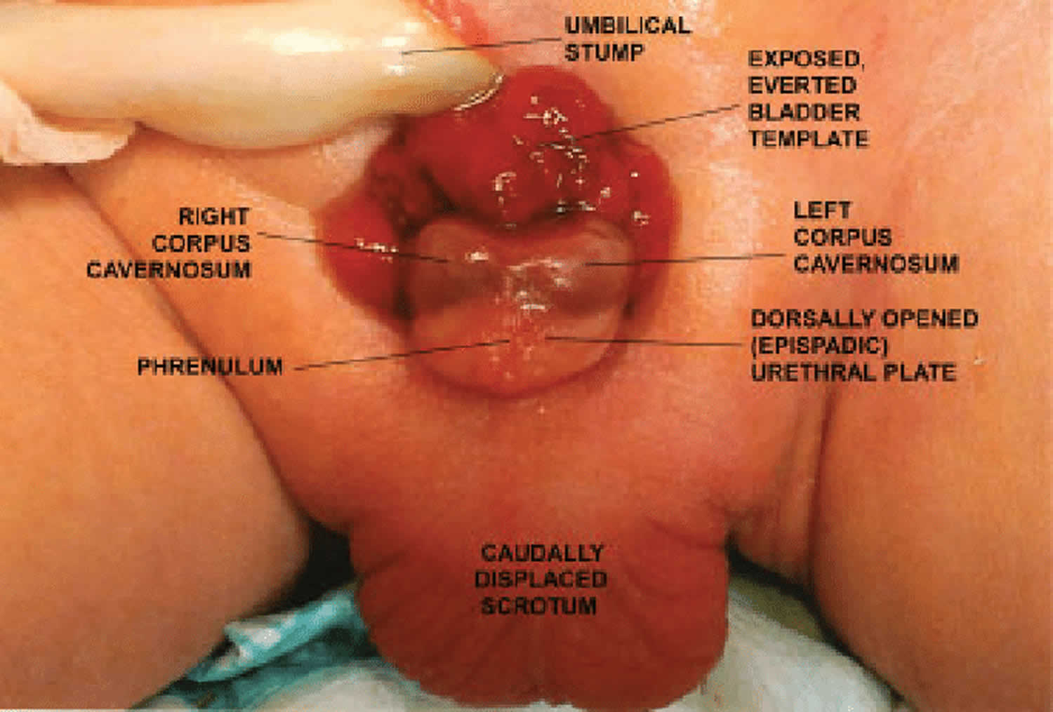 bladder exstrophy