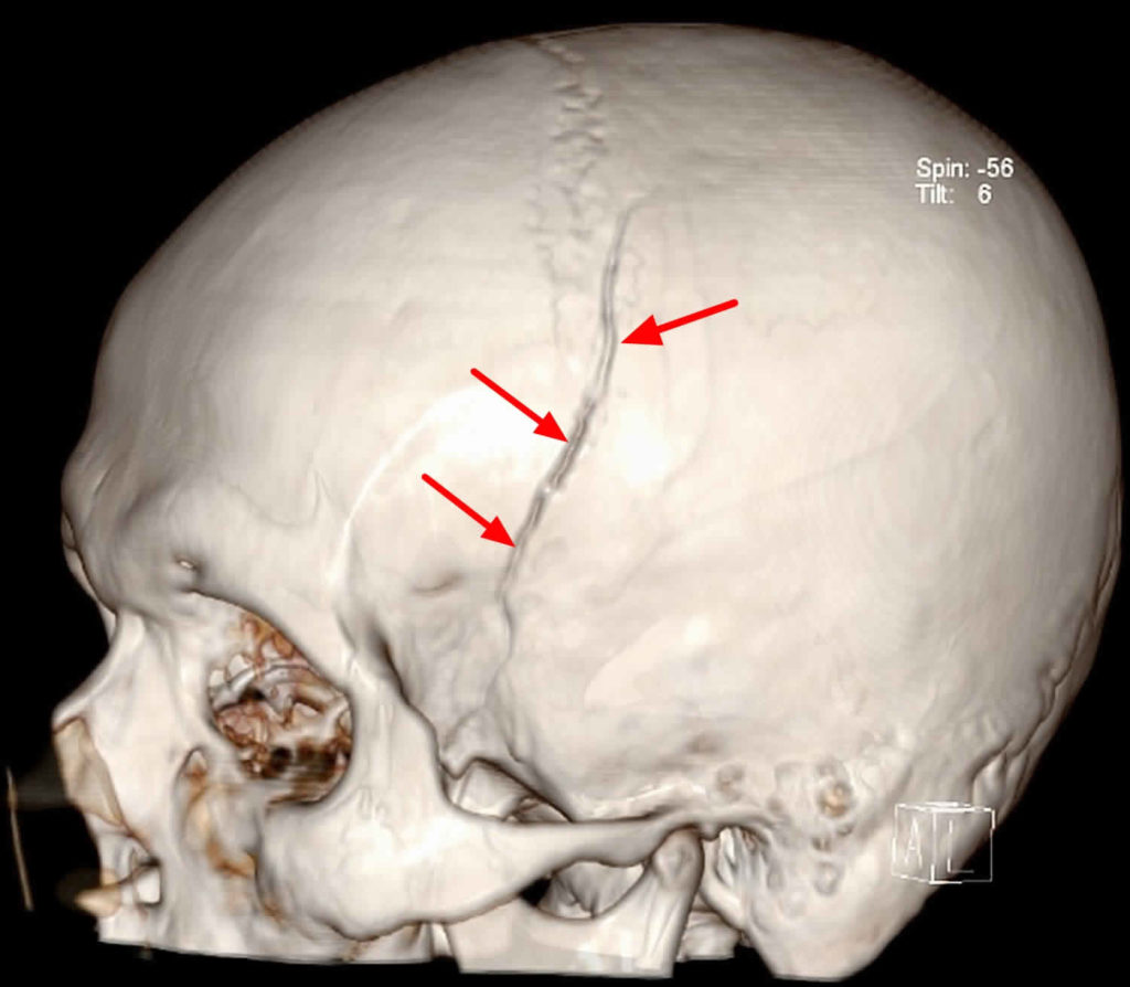 Epidural Hematoma Causes, Signs, Symptoms, Diagnosis & Treatment