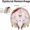 epidural hematoma – intracranial