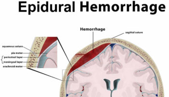 epidural hematoma – intracranial