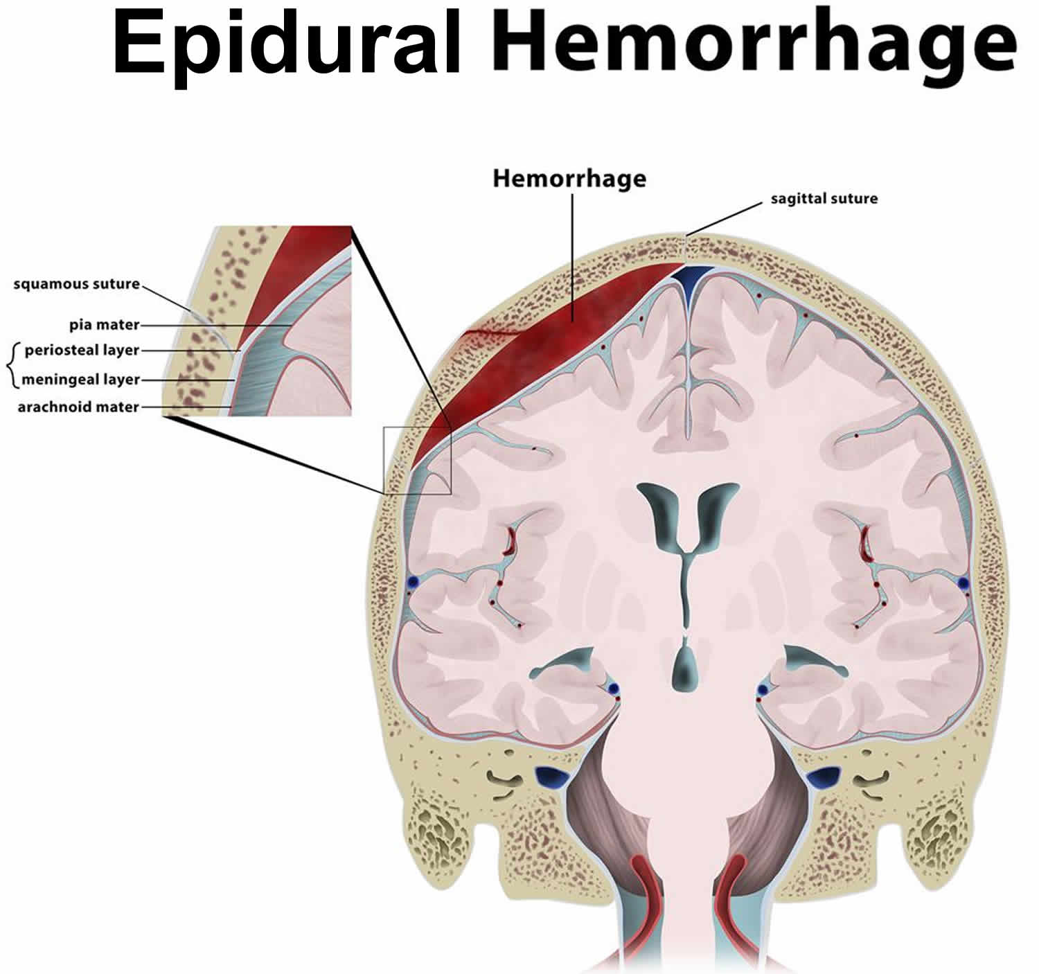 What is the most common cause of epidural hematoma?