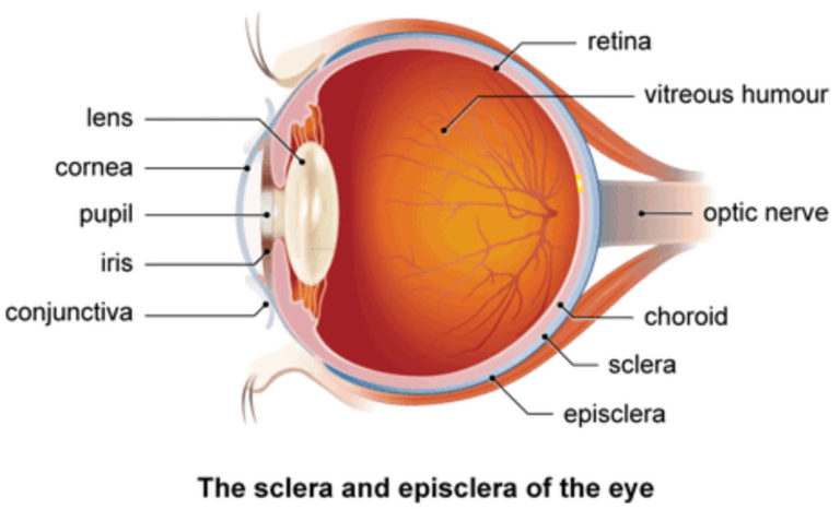 Episcleritis, nodular episcleritis, causes, signs, symptoms & treatment