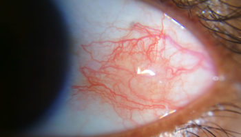 episcleritis