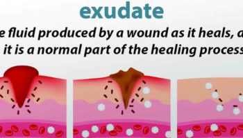 exudate