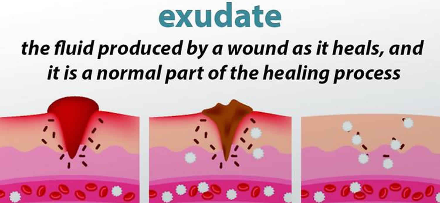 Exudate definition, types and difference between transudate and exudate