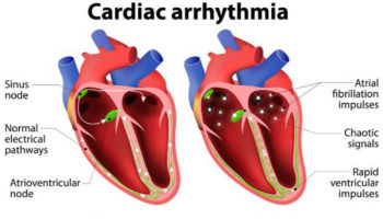 heart dysrhythmia