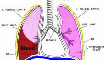 hemothorax