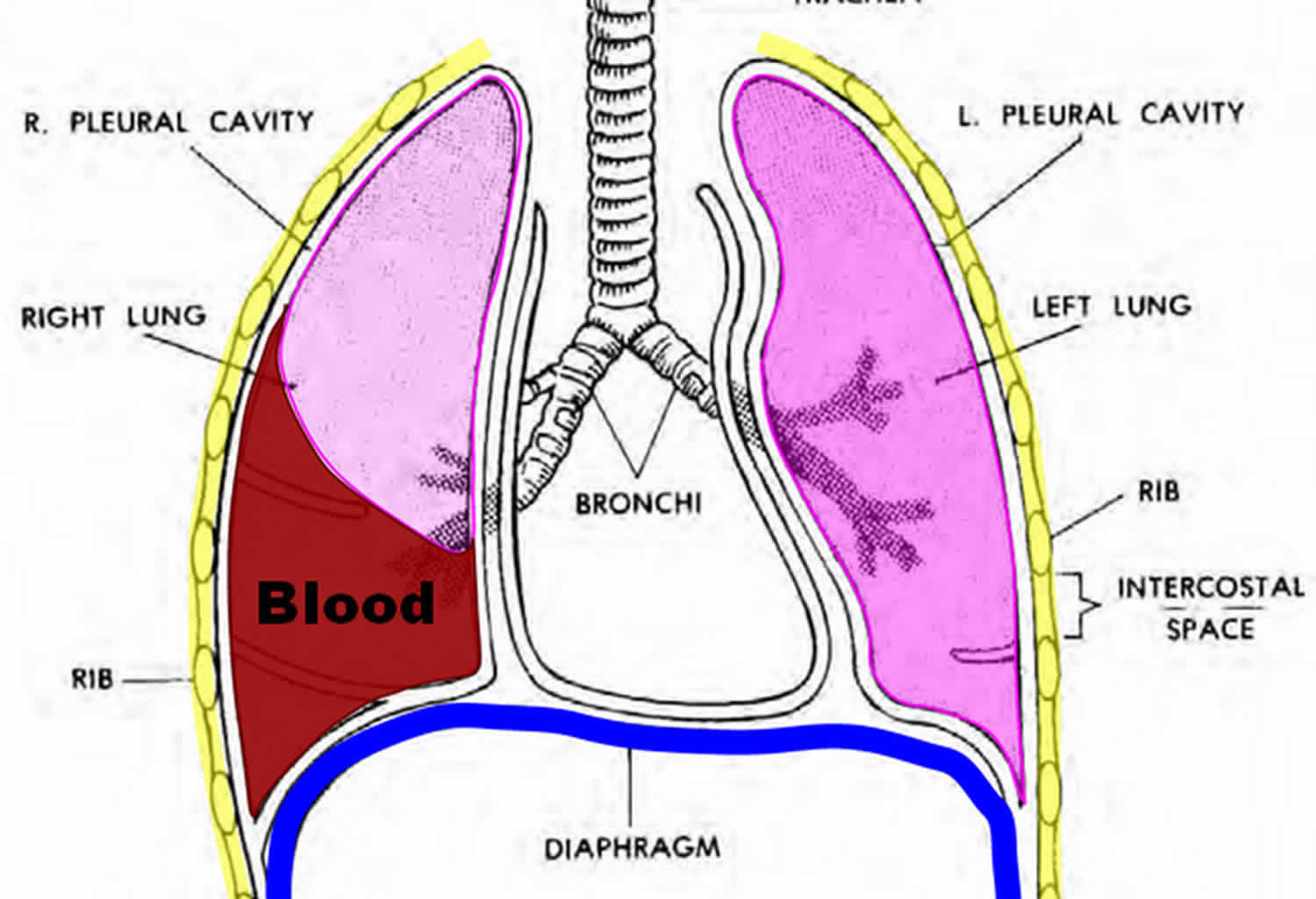 Hemothorax causes, signs, symptoms, diagnosis & hemothorax treatment