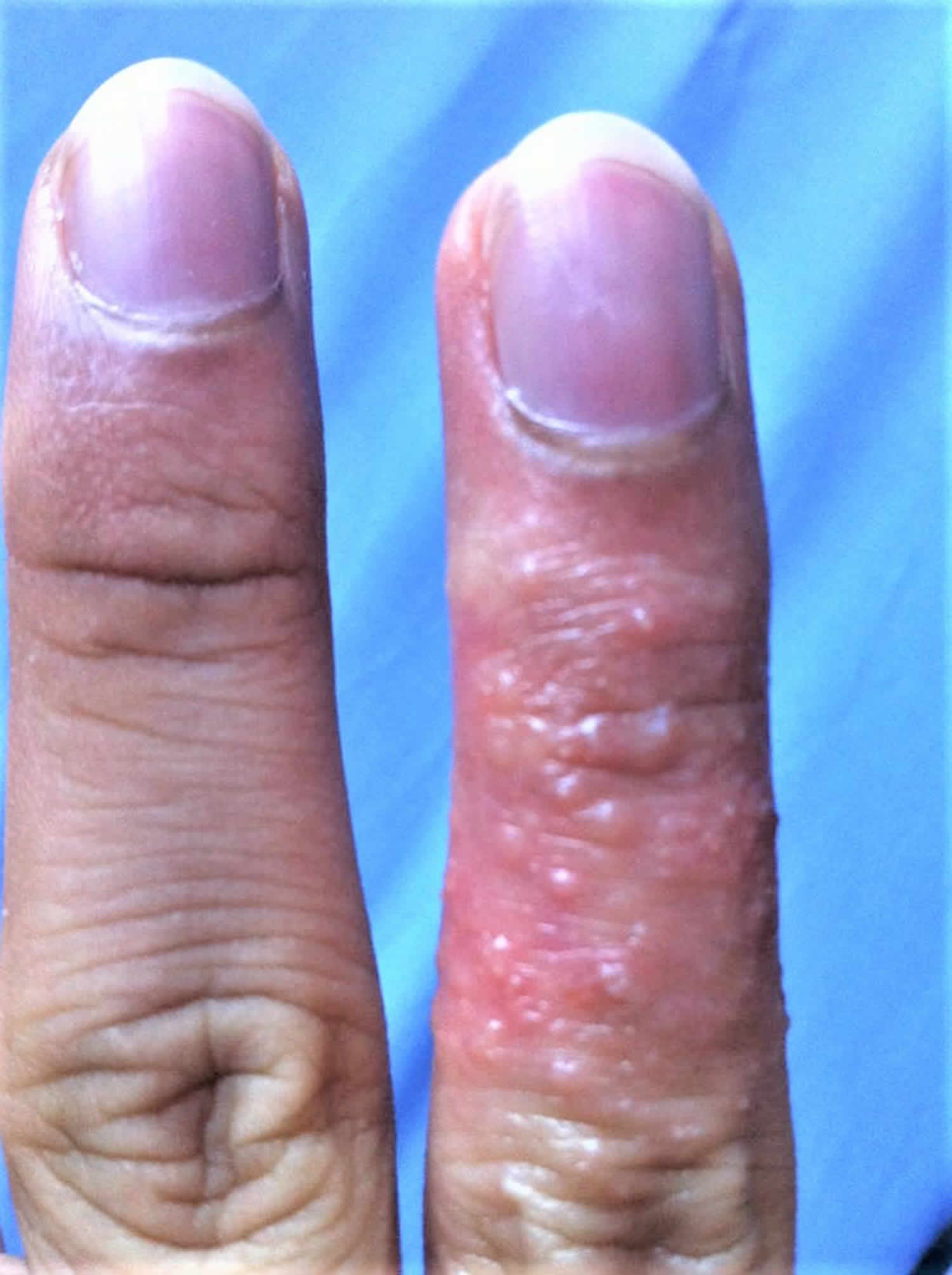 nails diseases ppt pdf - د. سلام التميمي - Muhadharaty
