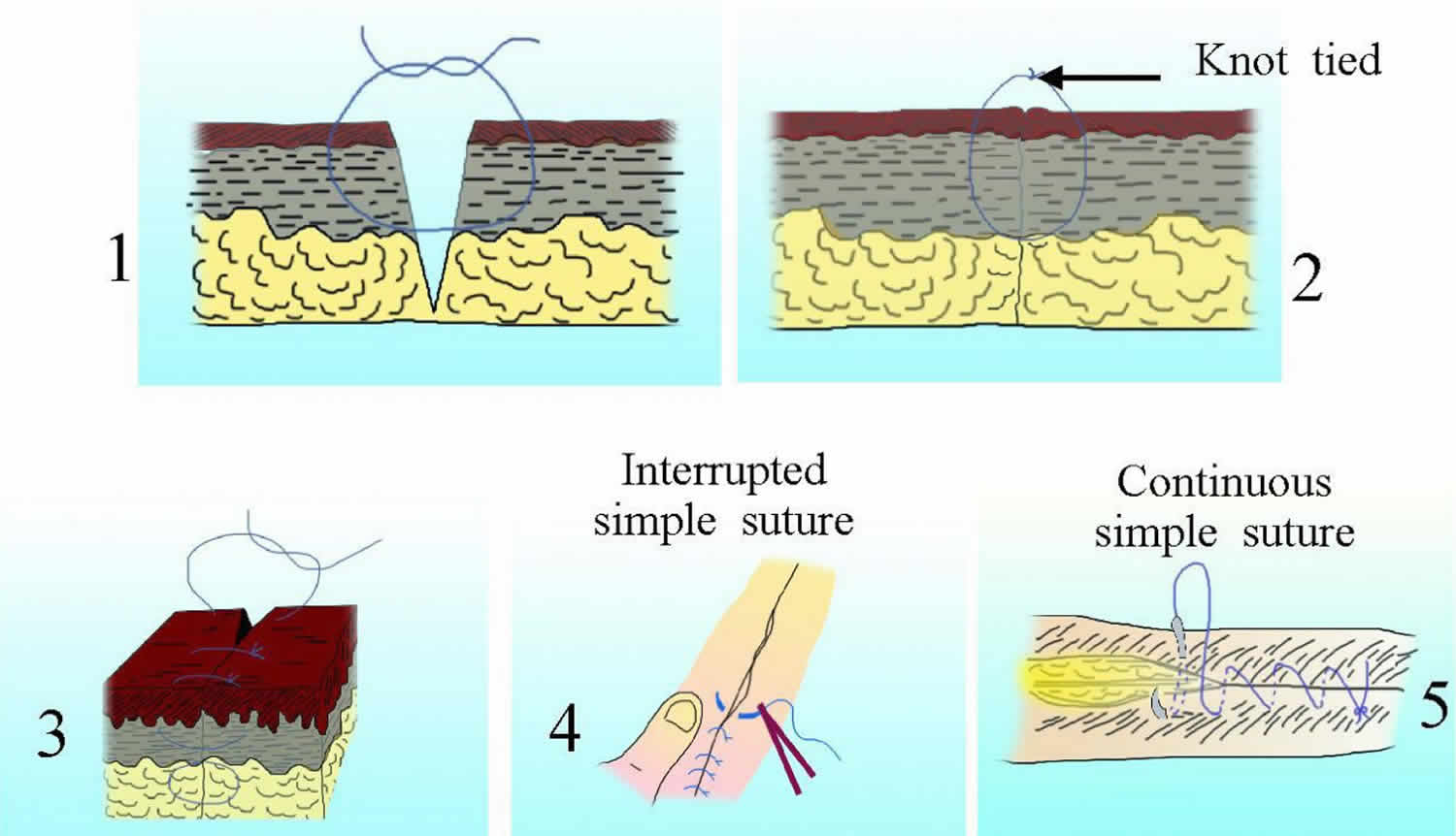 Types Of Suture For Wound Closure