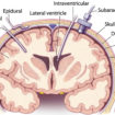 intracranial pressure