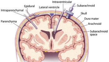 intracranial pressure