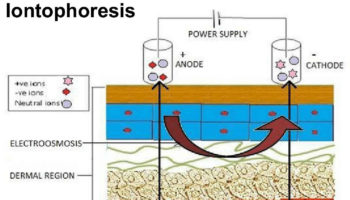 iontophoresis