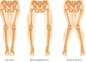 Knock knees causes, signs, symptoms, diagnosis & knock knees treatment