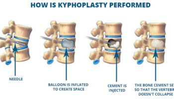 kyphoplasty