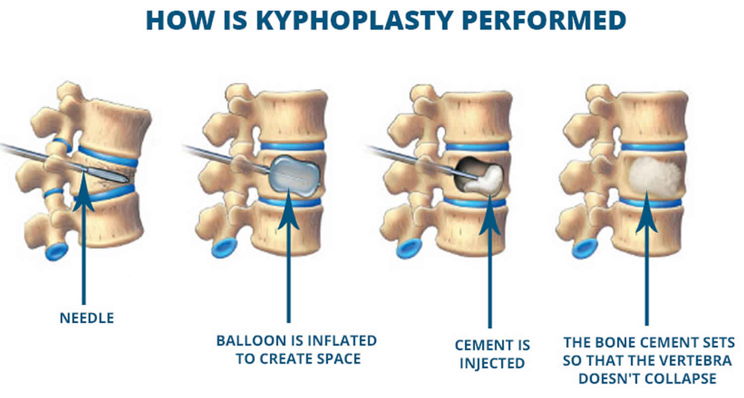 kyphoplasty