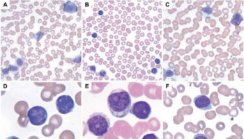 leukocytosis