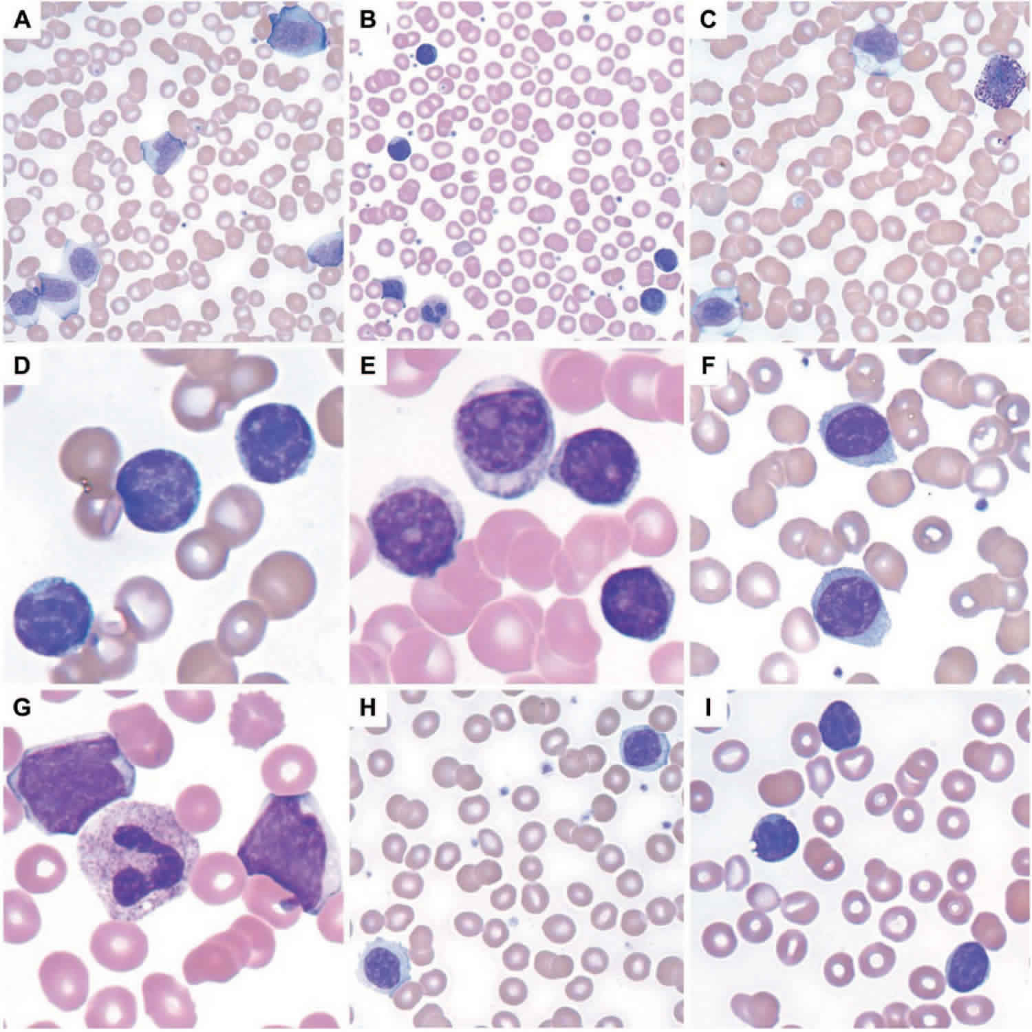 Differential Of Leukocytosis at Audrey Houck blog