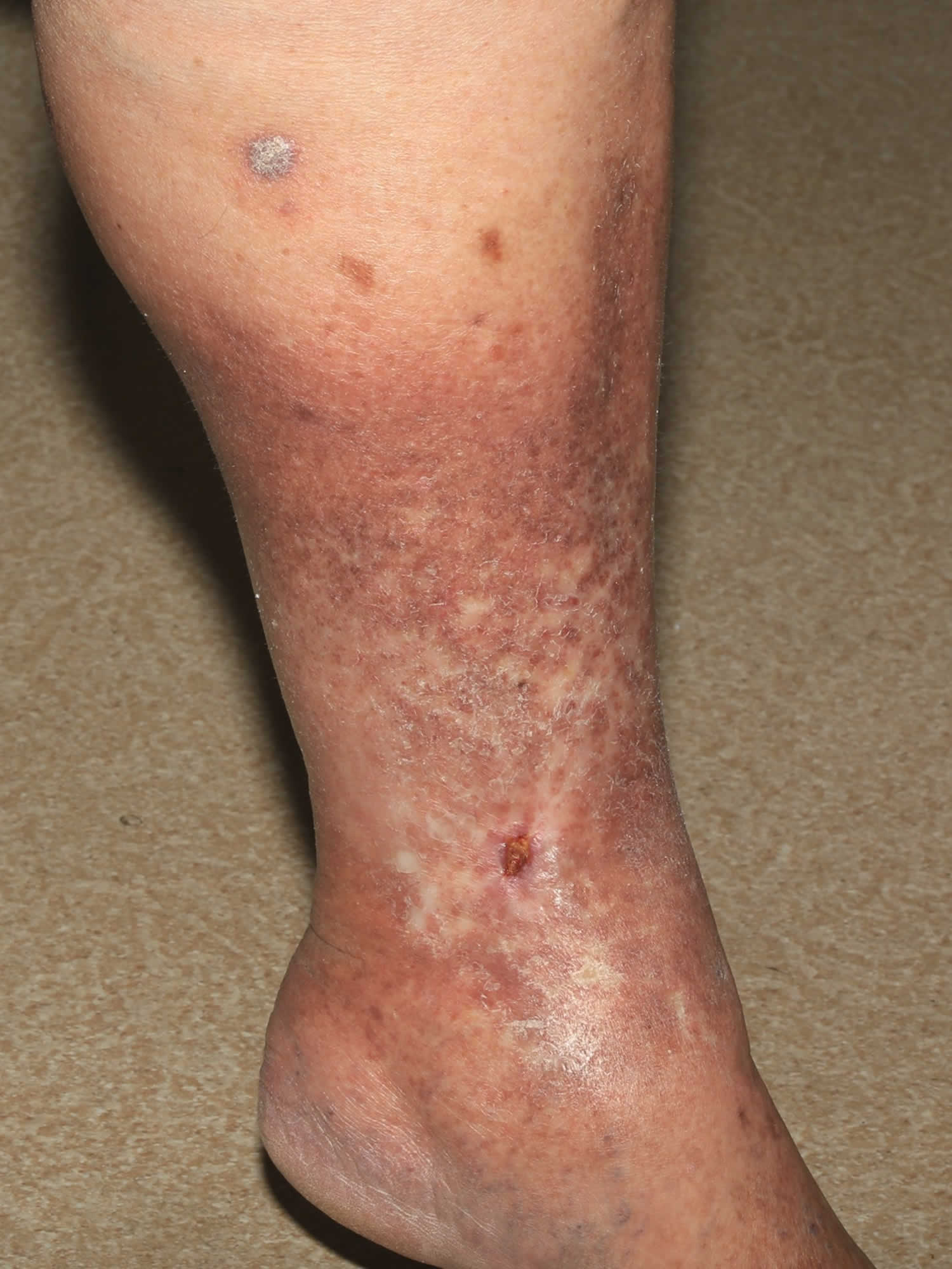 venous-stasis-ulcer-pictures-symptoms-causes-treatment