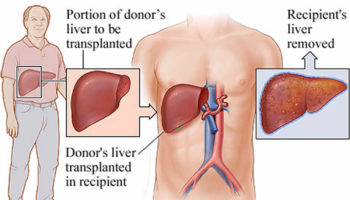 liver transplant