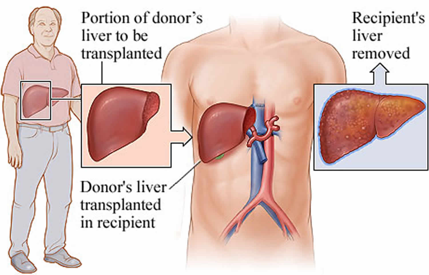 living donor liver transplant