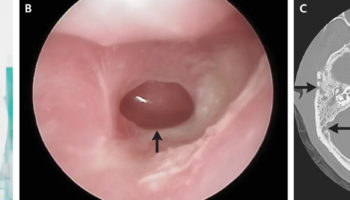 mastoiditis