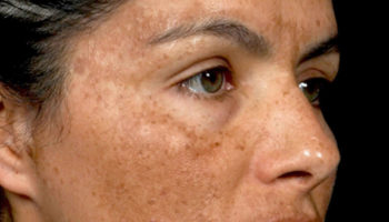 melasma