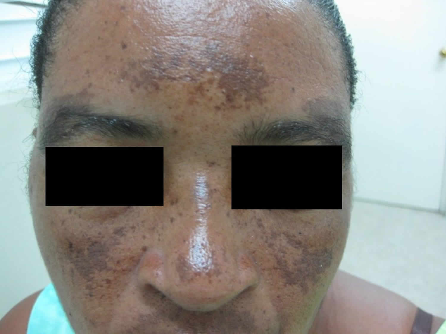 Melasma Causes Symptoms Diagnosis Best Treatment For Melasma On Face