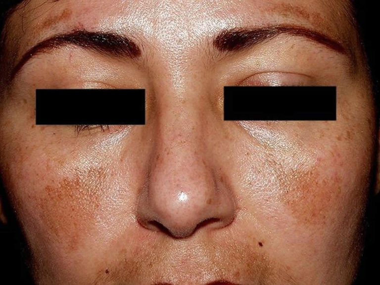 Melasma Causes Symptoms Diagnosis And Best Treatment For Melasma On Face 6622