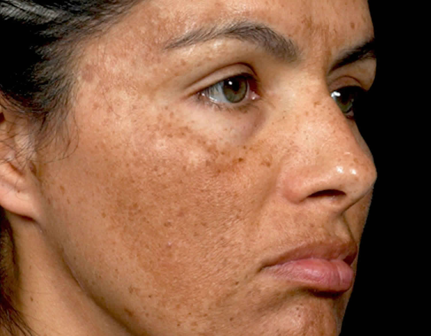 Melasma Causes Symptoms Diagnosis Best Treatment For Melasma On Face