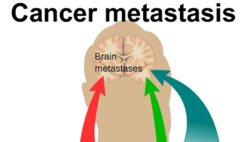 metastasis