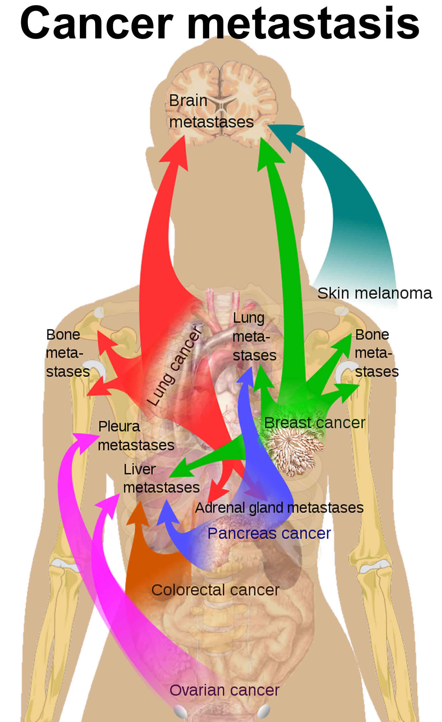 Que Es Un Cancer Metastasico