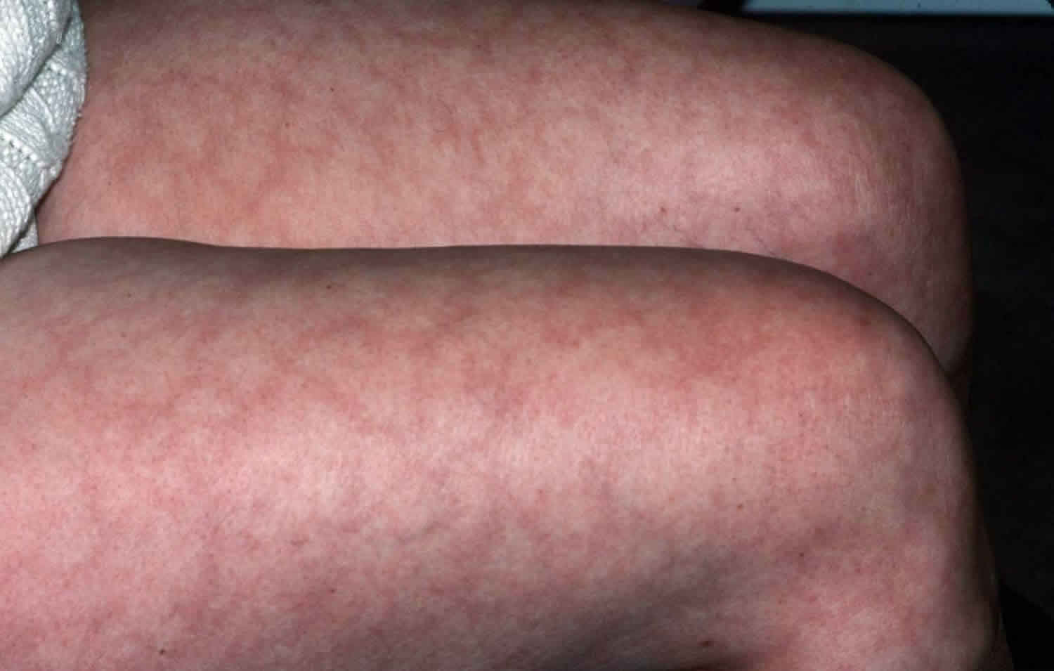 mild-livedo-reticularis