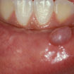 mucous cyst lip