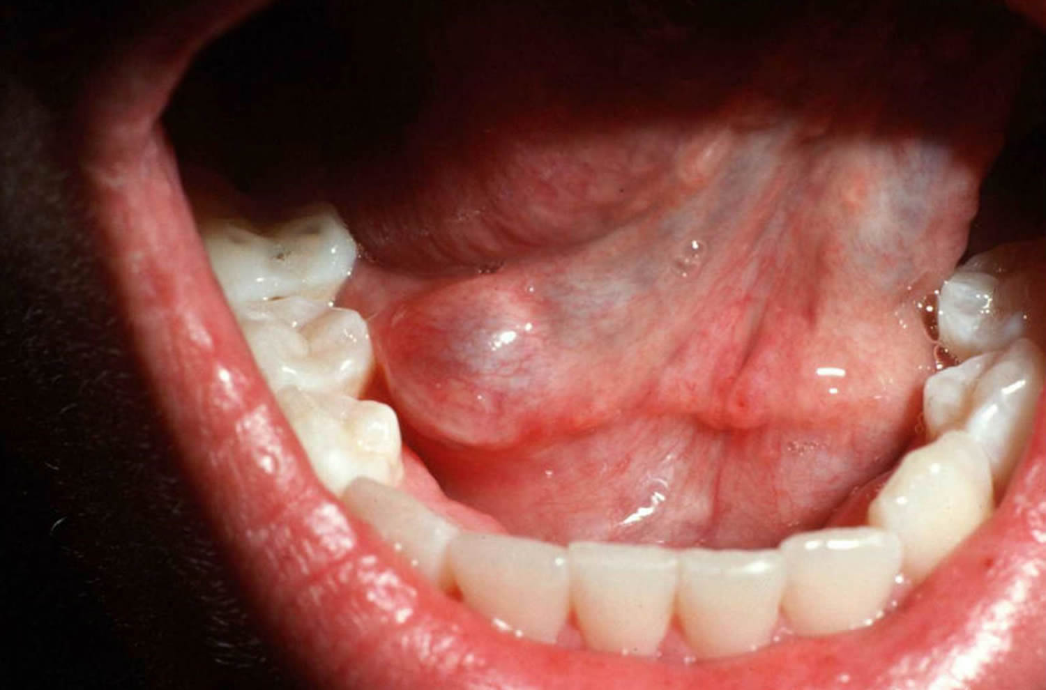 Mucous cyst on the floor of the mouth